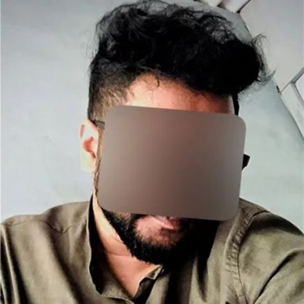 Same patient after hair transplant, frontal hairline
