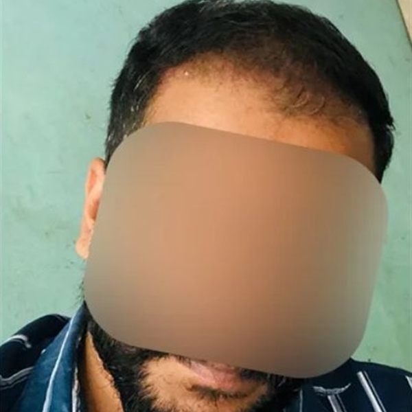 CHT patient before treatment, frontal hairline
