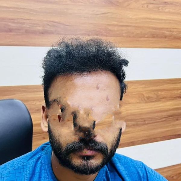 Same patient after hair transplant, hairline and density