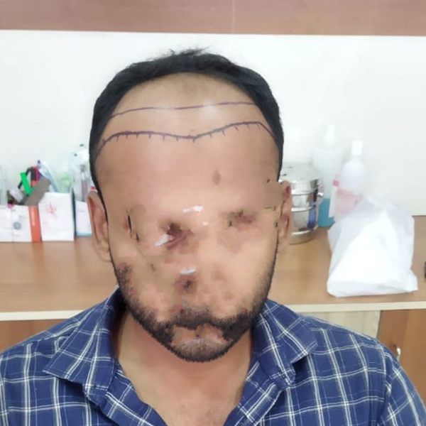 CHT patient before treatment, hairline and density