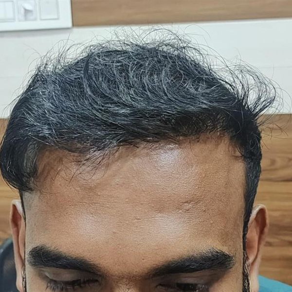 Same patient after hair transplant, front and mid-scalp