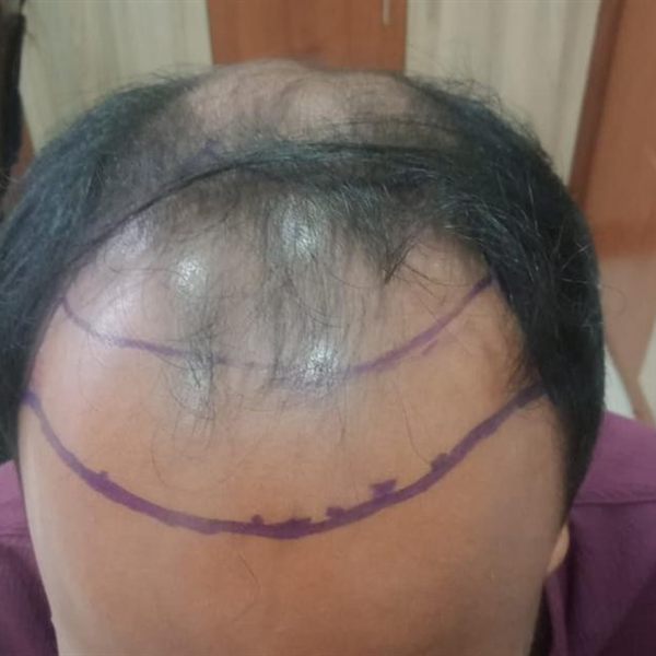CHT patient before treatment, front and mid-scalp