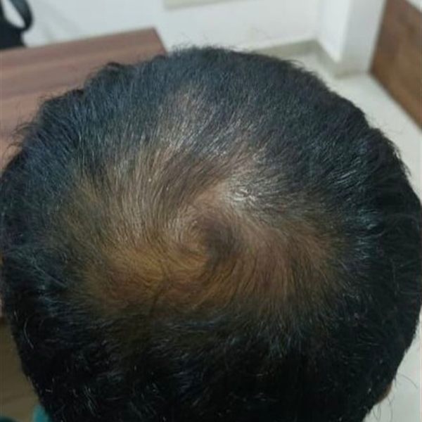 Same patient after GFC therapy, crown thinning