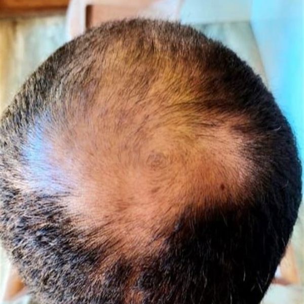 CHT patient before treatment, crown thinning