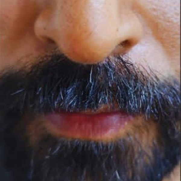 Same patient after facial hair transplant, moustache