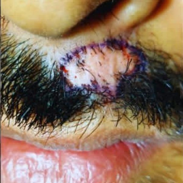 CHT patient before treatment, moustache